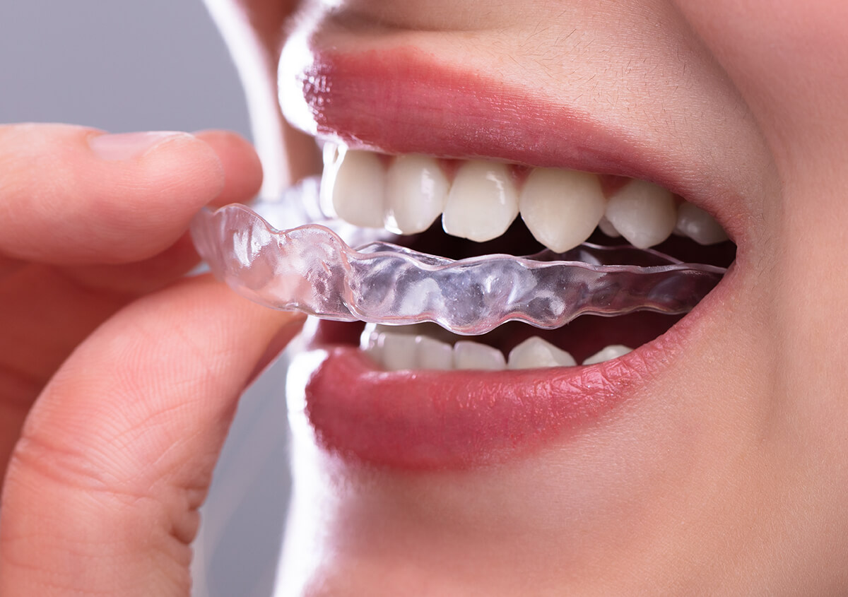 Clear Aligners - Town Center Dentistry & Orthodontics